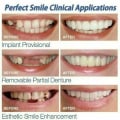 Miniatyrbild 4 av 5: Smile Knäpp på löständer Nedre och övre tandfasader Set Cover null none