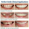 Miniatyrbillede 5 af 5: SQBB Perfekt Smil Påsætning Øvre Falske Tænder Dental Veneer Gebis Dæk Sæt null ingen