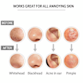 Miniatyrbilde 5 av 5: (Spesialkampanje) CQBB Blackhead Remover, Pimple Popper i rustfritt stål