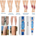Miniatyrbild 4 av 5: (Specialerbjudande) Veinshealth Åderbråck Blå Ljusterapi Set, behandling av åderbråck Blå Ljus Laser Behandlingspenna, åderbråckskräm 1pen x 2cream