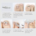 Miniatyrbillede 3 af 5: Pedicure Recover Embed Toe Nail Indgroet tånegl Corrector Treat one size