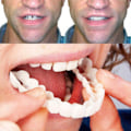 Miniatyrbilde 5 av 5: 4-delt ComfortFlex hvite simulerte proteser med finer - Øvre og nedre tenner proteseomsorg for menn og kvinner - Fleksibel, komfortabel, en (FMY) White 2pc upper teeth + 2pc lower teeth