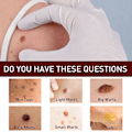 Miniatyrbilde 2 av 5: Jaysuing Verruca Fjerning av flytende penn for Nevus Care Pen For Verruca Fjerner Sharp Verruca, Barb Fjerner Filamentous Verruca, Spot Nevus Removing Pen