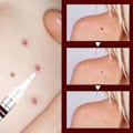 Miniatyrbillede 3 af 5: Jaysuing Verruca Fjernelse af flydende pen til Nevus Care Pen til Verruca Fjernelse af skarpe verruca, modhager til fjernelse af filamentøs verruca, plet-Nevus fjernelse af pen