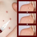 Pikkukuva 3 / 5: Jaysuing Verruca Removing Liquid Pen For Nevus Care Pen For Verruca Poista Sharp Verruca, Barb Removing Filamentous Verruca, Spot Nevus Removing Pen