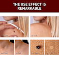 Miniatyrbillede 4 af 5: Jaysuing Verruca Fjernelse af flydende pen til Nevus Care Pen til Verruca Fjernelse af skarpe verruca, modhager til fjernelse af filamentøs verruca, plet-Nevus fjernelse af pen