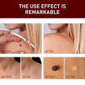 Pikkukuva 4 / 5: Jaysuing Verruca Removing Liquid Pen For Nevus Care Pen For Verruca Poista Sharp Verruca, Barb Removing Filamentous Verruca, Spot Nevus Removing Pen