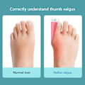 Miniatyrbild 1 av 2: Hallux Valgus Korrigerare, Stortåseparator med Justerbart Band, Mjuk Gel Bunion Splint för Smärtlindring och Icke-Kirurgisk Hallux Valgus