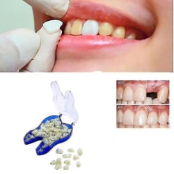 Tillfälliga tandproteser blockerar övre proteser, fanerproteser, saknade tänder
