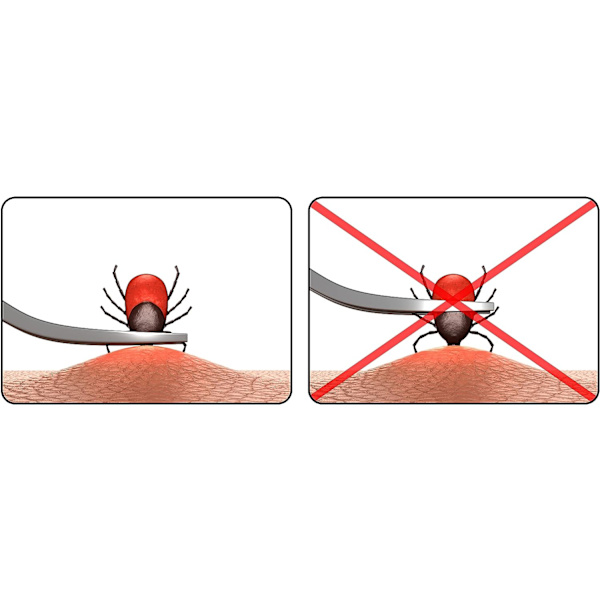 Set med 3 fästingkrokar/3 stycken - Anti-fästingpincett för katter, D
