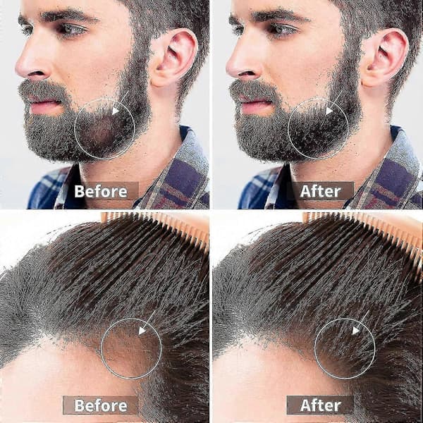 Dermaroller för hår- och skäggväxt - Microneedling-roller för ansikte, kropp och hårbotten