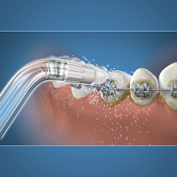 Waterpik, oikomishoitoon tarkoitetut kärjet ja huuhtelukärjet.