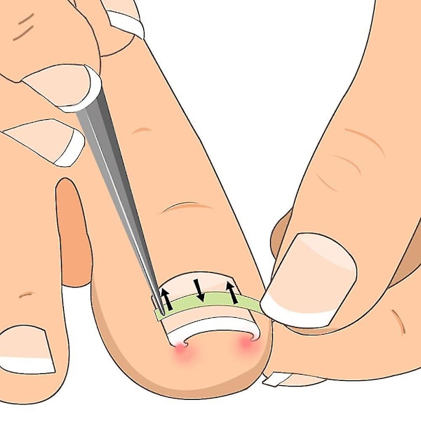 10 st Inväxta Naglar Pedikyr Verktygssats - Rätande Klämma & Böjd Stöd För Tjock Paronychia