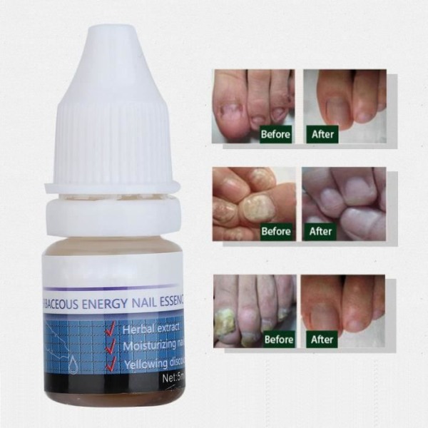 Qiilu Nail Treatment 5ml Kraftfull Leuonychia Treatment Anti Fungus Ört- Örtextraktlösning