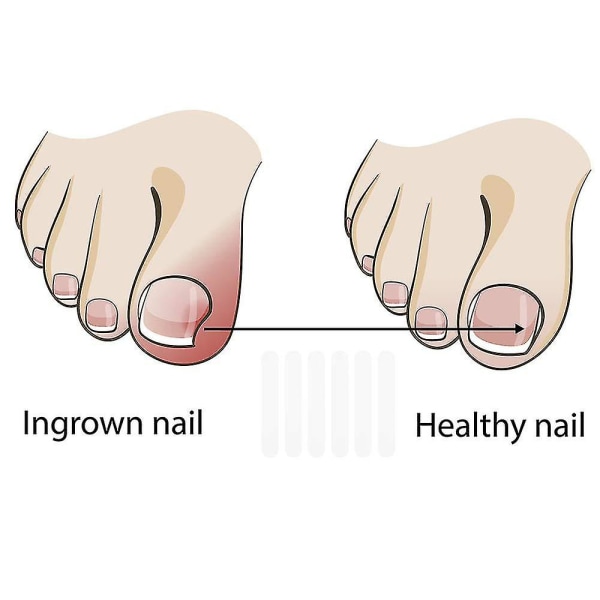 10 stykker inngrodde tåneglkorrigeringsstrimler tåneglkorrigeringspute
