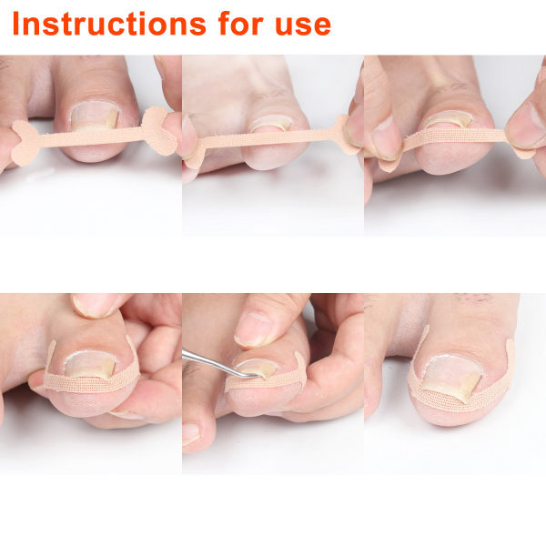 6 klistermärken för tånagelkorrigering, tejp för behandling av osteokondrit