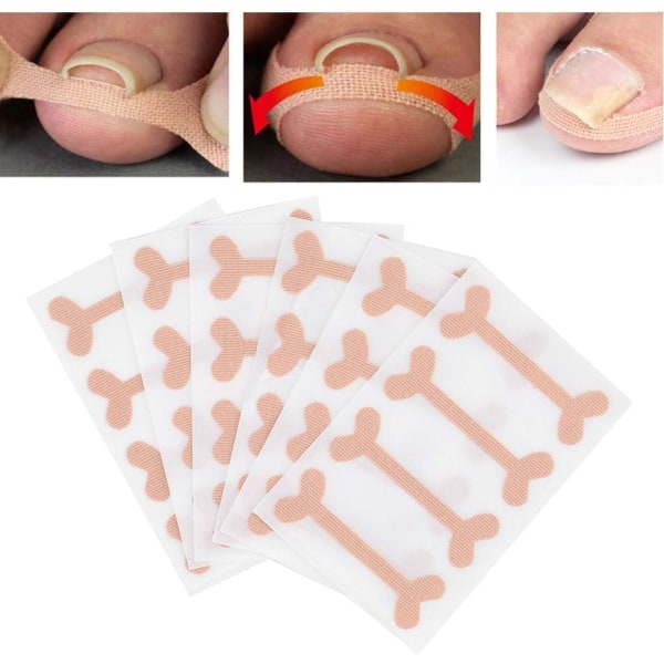 6 klistermärken för tånagelkorrigering, tejp för behandling av osteokondrit