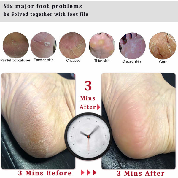 Fodfil Callus Remover Fodskrubber, Professionel Pedicure Fodrasp Fjerner Revnede Hæle, Død Hud, Hård Hud