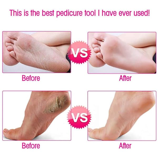 Electric Callus File - Adjustable Speed, with 60 Replacement Pads, Powerful Remover