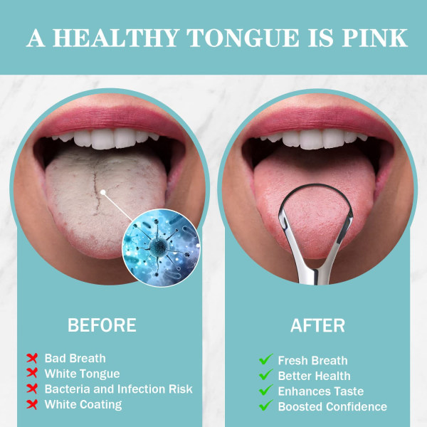 2 Pack Tongue Kaavin ruostumatonta terästä vähentää pahanhajuista hengitystä aikuisten lasten suunhoitoon