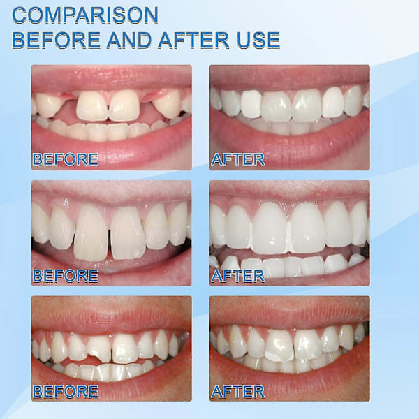 Sladdlös dental guttaperka tandköttsskärare för inre tänder guttaperka skärare + 4 spetsar 12