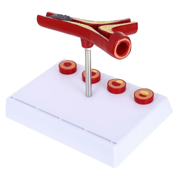 Aterosklerose Medicinsk Model Blodkar Anatomisk Model Kardiovaskulær Model