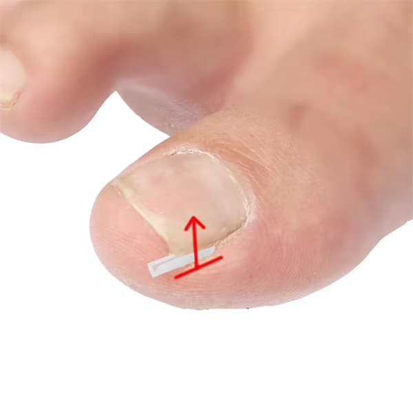 Nageltrångspads 50st  Bekväma & Lättanvända för Alla Naglar