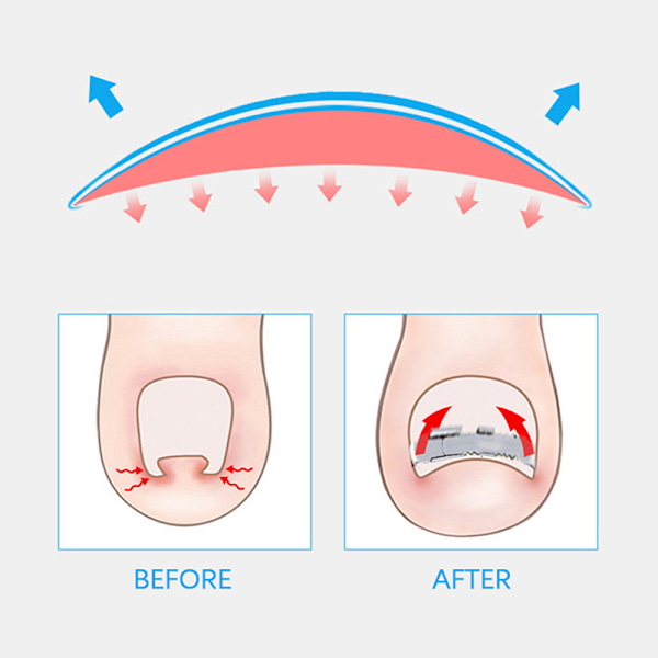 Sisäänkasvaneiden varpaiden kynsien kiinnitysaine Embed Toenail Correction Lifter pedikyyri