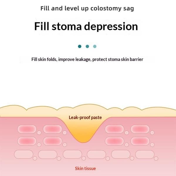 Hudvårdspulver Stomitillbehör Efter Operation Kräm Stomi B