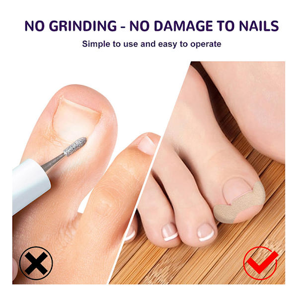 50 kpl sisäänkasvaneiden varpaiden kynsien korjaustarra Nail Strip Corrector St