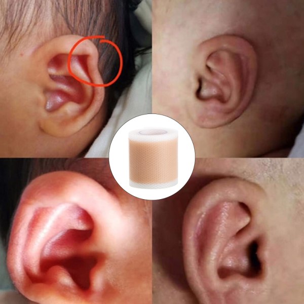 Korrigering av silikon för baby utskjutande öron 5