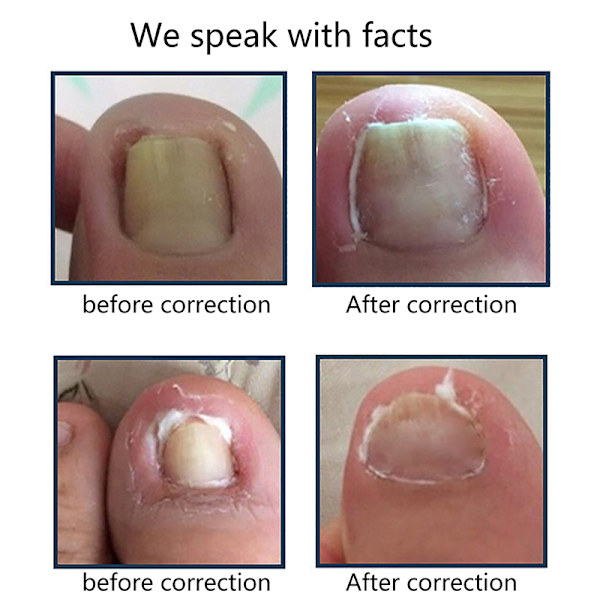 3 par främre spikkrok/gummiband Nail Art Inåtväxt tåspik C