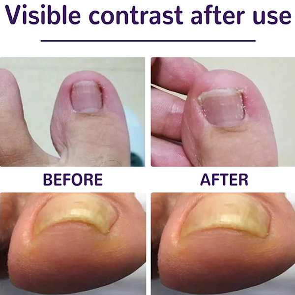 50 kpl sisäänkasvaneiden varpaiden kynsien korjaustarra Nail Strip Corrector St
