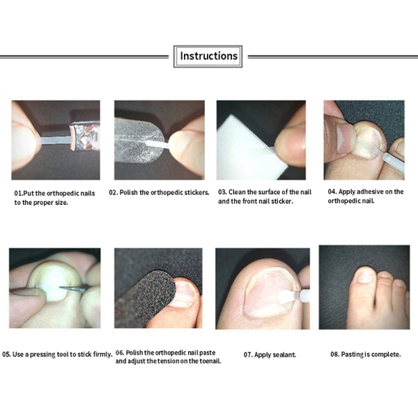 10stk Behandling av inngrodde tånegler Korreksjon av inngrodde tånegler Elas