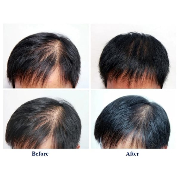 Kirkland Minoxidil Men Hair Regrowth 60ml Hair Loss