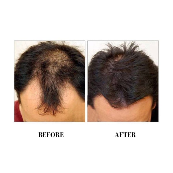 3x Kirkland Minoxidil Men Hair Regrowth 60ml Hair Loss