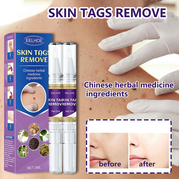 Skin Tag Remover Mycket effektiv och extra styrka Skin Tag And Mole Remover och Corrector 2PCS