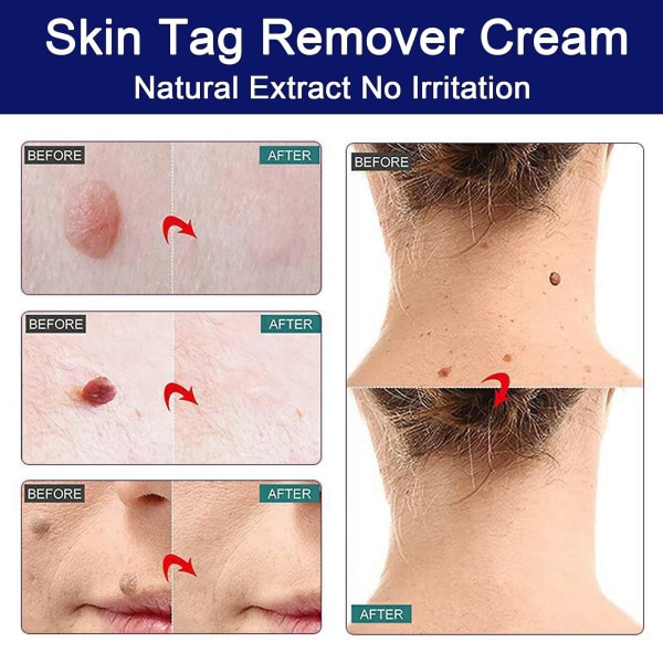 Skin-tag-removal Cream, Skin Tag Remover-vårta Removal Cream Snabbverkande, Tags & Moles Remover, säker och smärtfri 2PCS