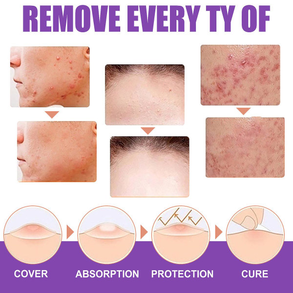 Skin-tag-borttagare, vårtborttagningsmedel, ke vårta, hudtagsborttagare flytande, lämplig för ansikte och kropp, säkerställer mild och vanlig 1PCS