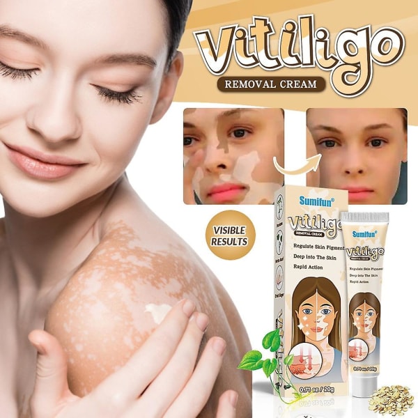 Vitiligo Cream Borttagning av vita fläckar Antibakteriell salva Behandla Leukoplakia Hud Melanin Reparation Medicinsk gips
