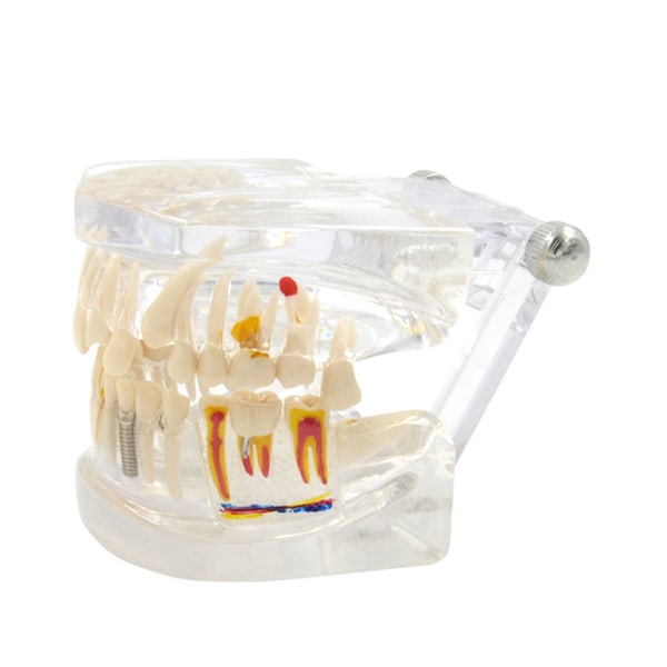 Transparent tandimplantatmodell Avtagbara tänder Bärbar sjukdom Tändermodell för tandläkare Medicinsk föreläsning Utbildningsanvändning