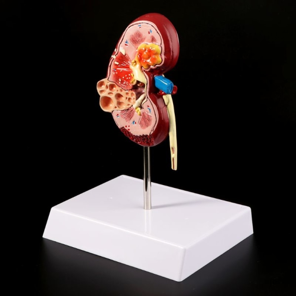 Mänsklig njursjukdom modell Medicinsk rekvisita modell Anatomi anatomi sjukdom patologi stenorgan undervisningsmaterial