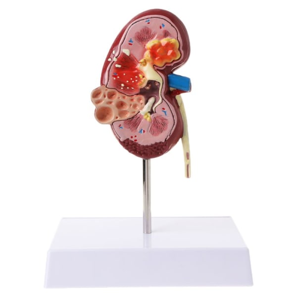 Mänsklig njursjukdom modell Medicinsk rekvisita modell Anatomi anatomi sjukdom patologi stenorgan undervisningsmaterial