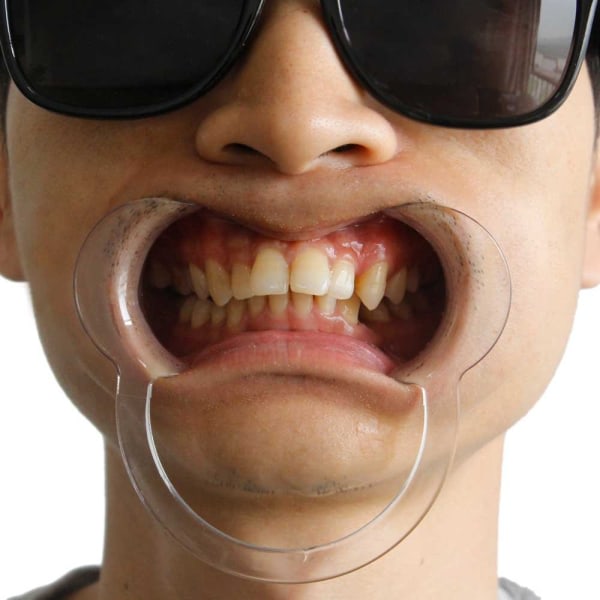 18 suukappaletta Speak Out -peliin, Dental Cheek Retractors
