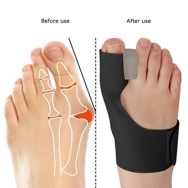 1st Tåavskiljare Orthotics Fötter Ben Tummen Justerare Black Right