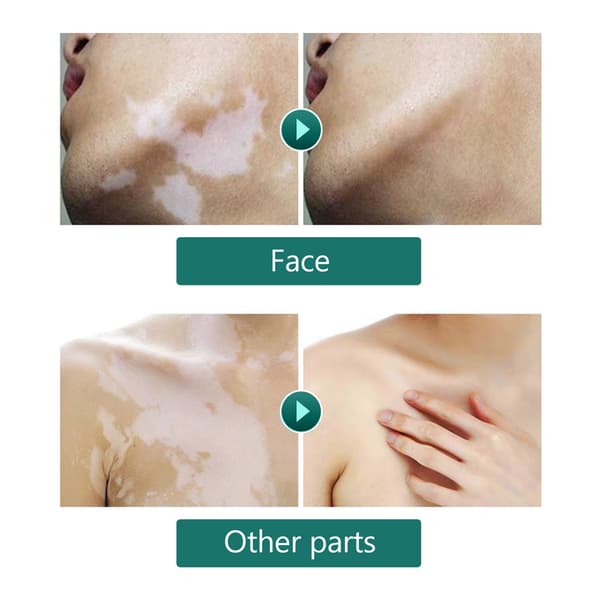 Vitiligo Concealer - Vandfast Makeup til Ansigt og Krop (20ml)