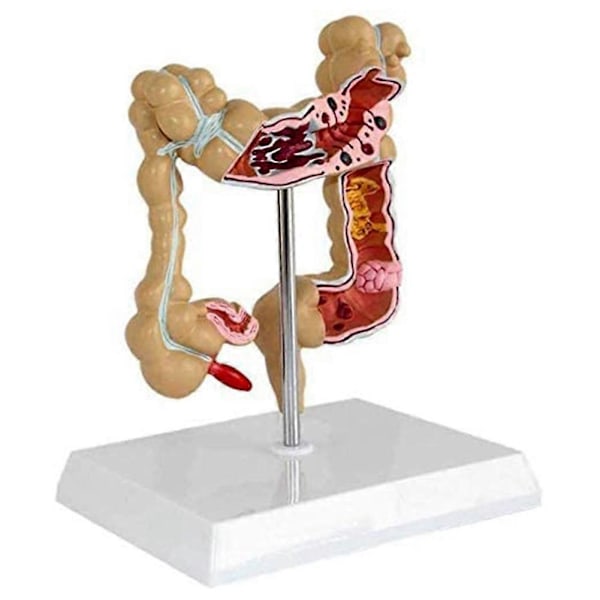 Patologisk tykktarmsmodell Stor tarmmmodell Gastrointestinal anatomisk modell