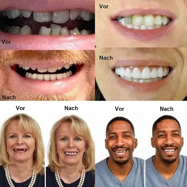 Instant Finer Tandproteser Falske tænder Smile Teeth Top Falske tænder