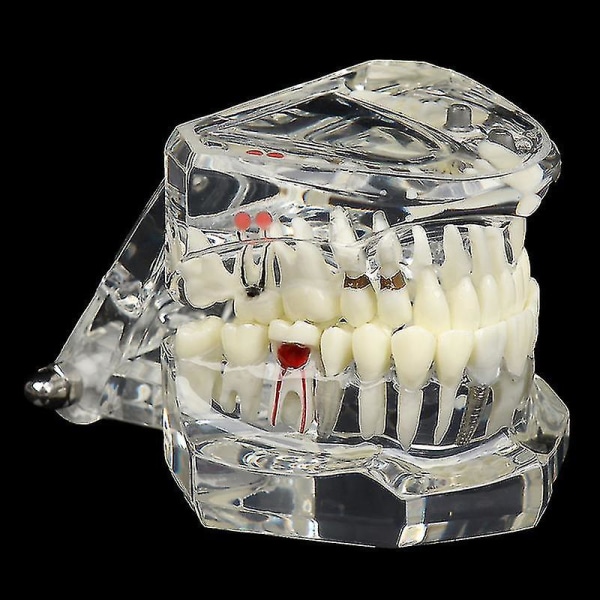 Tannmodell Teeth Implant Restoration Bridge Teaching for Study Tooth Science