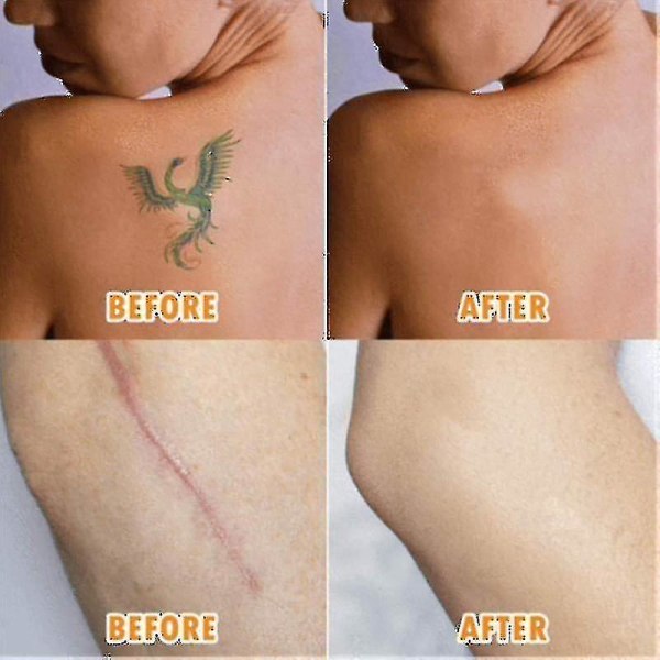 5-pak åndbar tatoveringsfejl-skjulningstape, ar Flaw-tildækningstape-klistermærker, tatoveringsbetræk og tildækningstape til hudskjolde